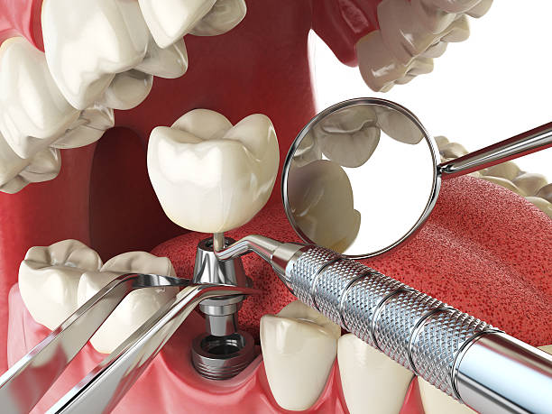 Best Emergency Tooth Extraction in Del Monte Forest, CA