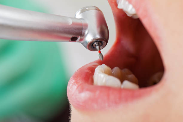 Best Emergency Treatment for Dental Infections or Abscesses in Del Monte Forest, CA
